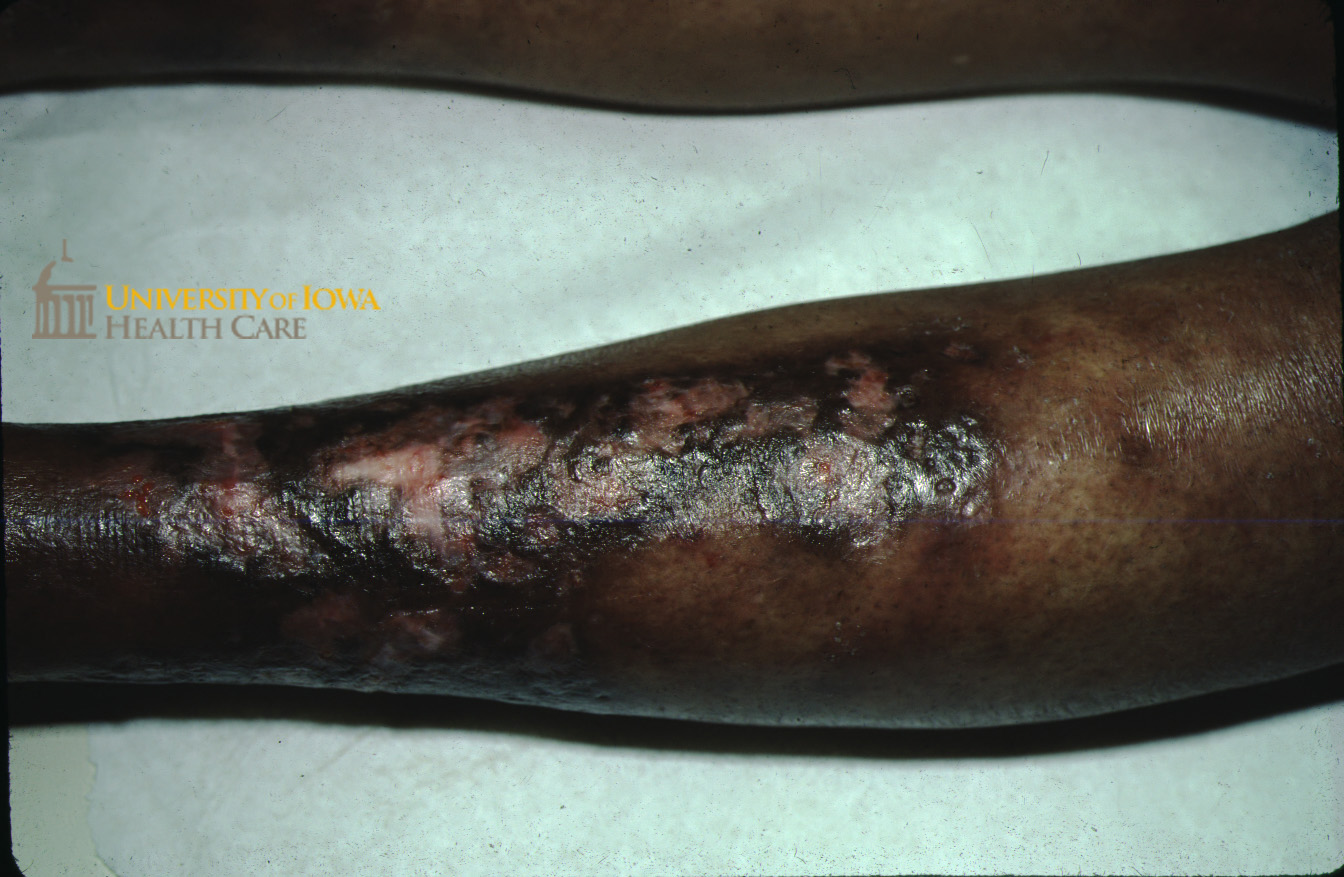 Ulcers after treatment with hydroxychloroquine. (click images for higher resolution).